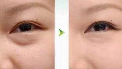 祛眼袋一般多少钱