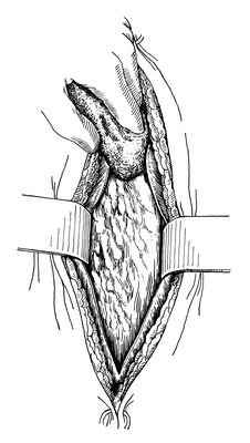 二期缝合的介绍