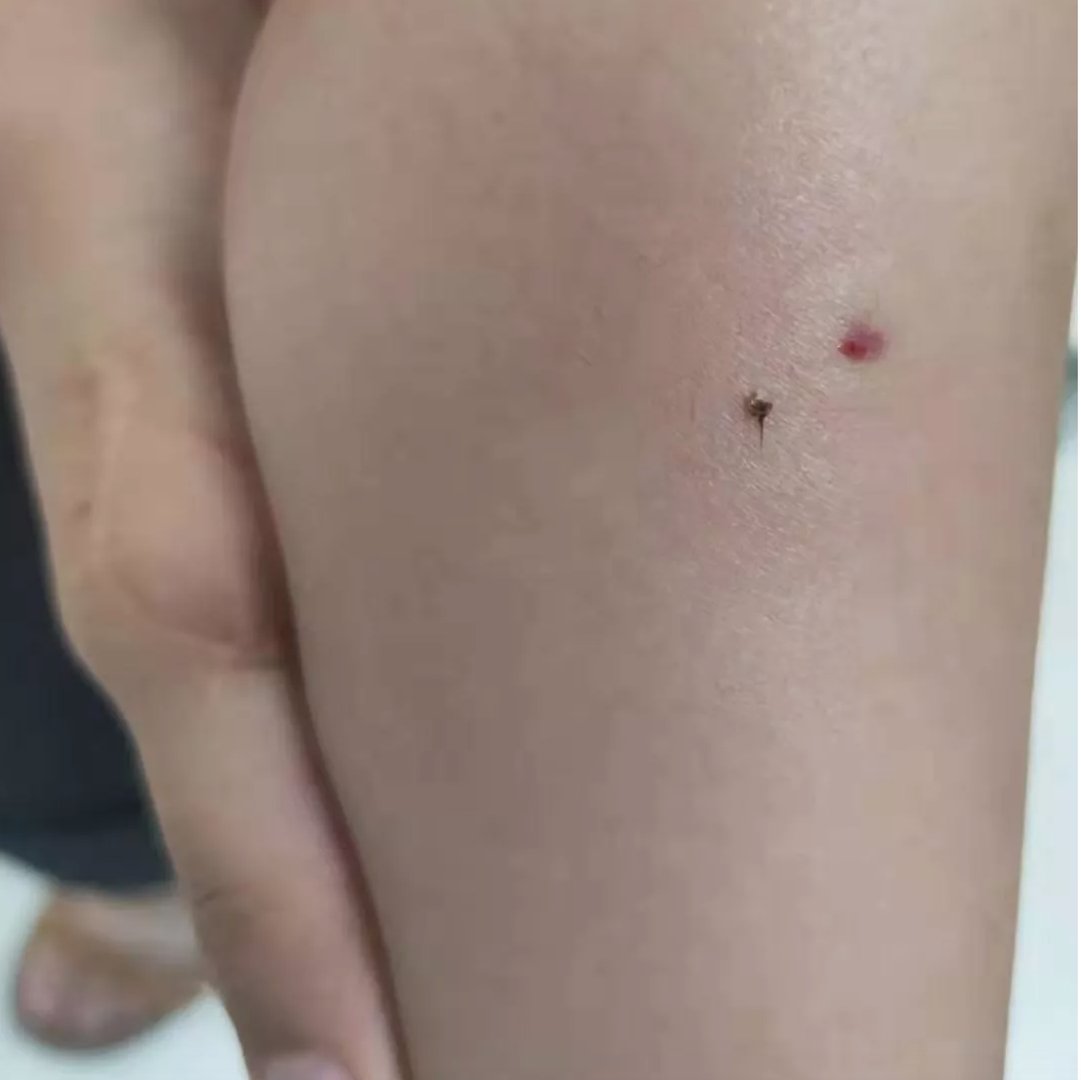 被马蜂蛰了，到底是用肥皂水还是用醋，怎么连大夫的说法都不一致。有明确知道的吗？