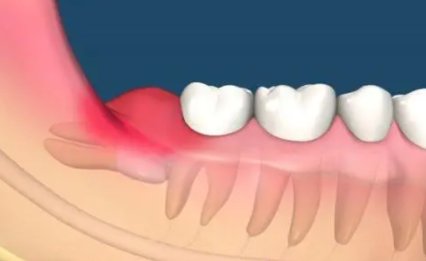 河南拔智齿是什么意思网络用语？