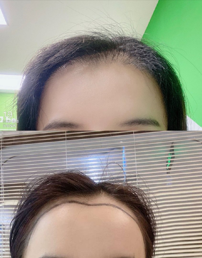 植发费用换算后超房价，这究竟是为何？