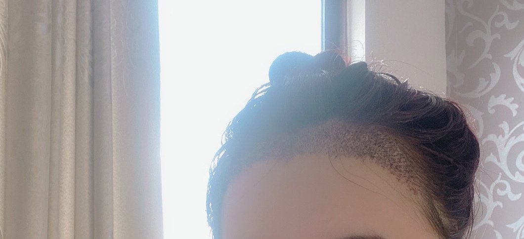 植发费用换算后超房价，这究竟是为何？