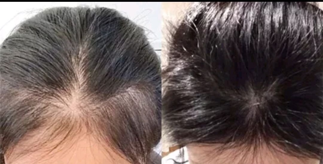 天津河津一大学女浴室满地秀发,为何连大学生患上了脱发?