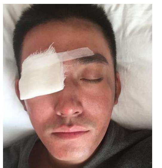 眼睛轻伤的判定标准及处罚？