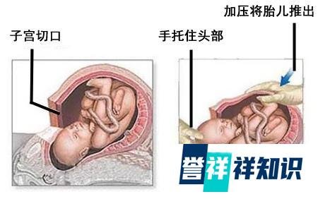应采儿直播生产过程，看完你就知道该选顺产还是剖腹产...