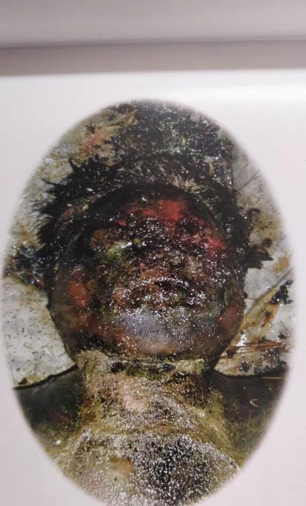 巨人观？腐败血水？法医带你认识死后晚期腐败现象。