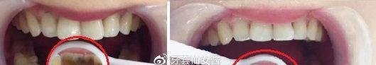 公布成都洗牙大概多少钱，货比三家低价洗牙！