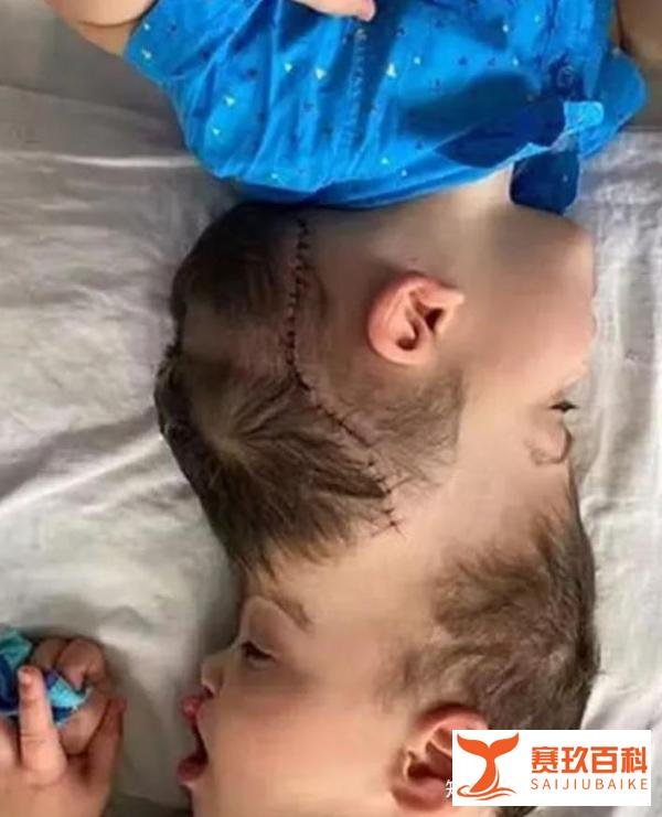 头连双胞胎被成功分离！为了这场手术，百名医生戴VR练了数月！