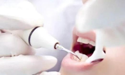 杭州洗牙一般要多少钱，洗牙需要多长时间？