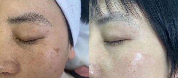 思兰朵焕颜祛斑霜效果如何，真的可以祛斑吗？