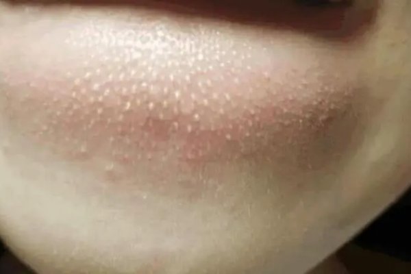 6年级小学生皮肤挤出白色东西是怎麽回事？