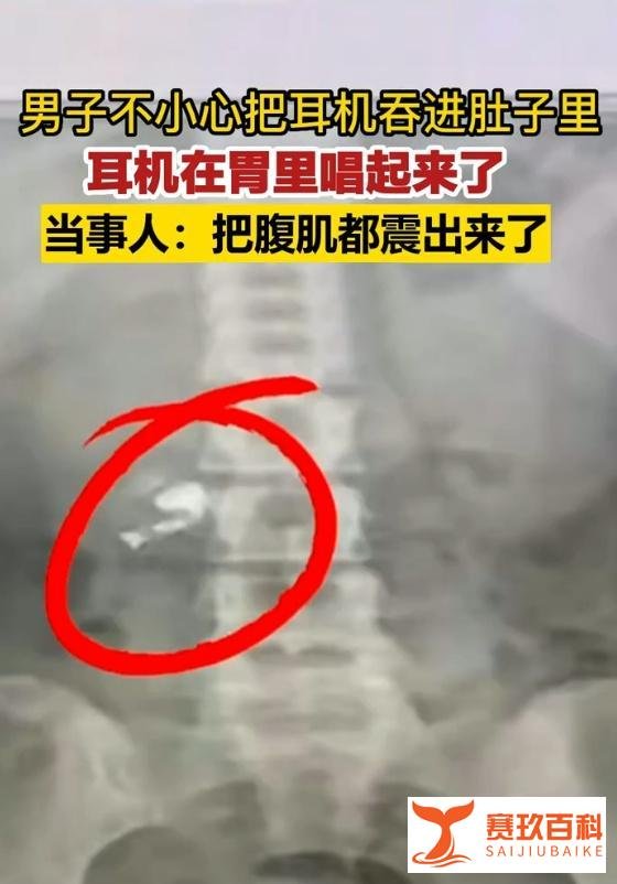 男子不小心把耳机吞进肚子,结果还在胃里唱起了歌
