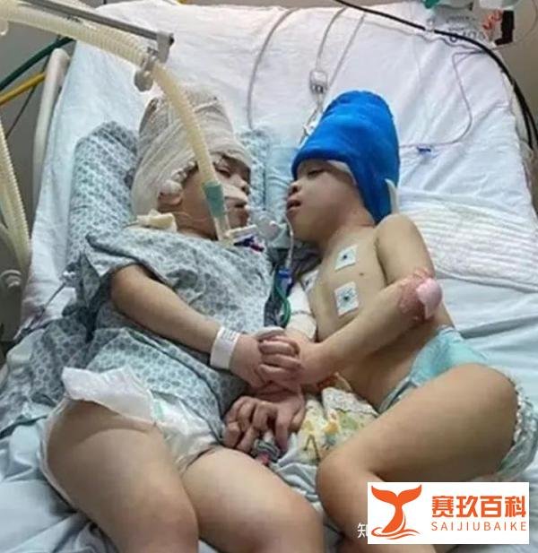 头连双胞胎被成功分离！为了这场手术，百名医生戴VR练了数月！