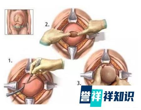 应采儿直播生产过程，看完你就知道该选顺产还是剖腹产...