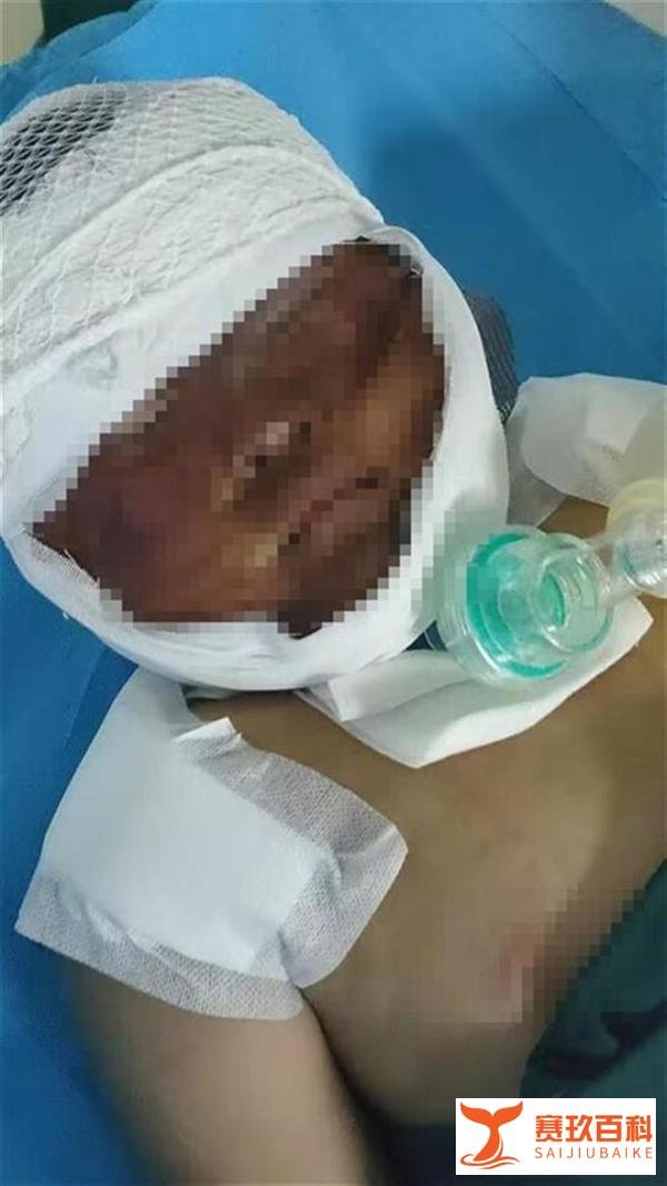 临沂一对年幼姐弟重度烧伤，妈妈和四名姨妈剃光头捐皮，姐姐已顺利完成手术