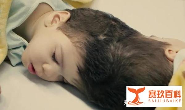 头连双胞胎被成功分离！为了这场手术，百名医生戴VR练了数月！