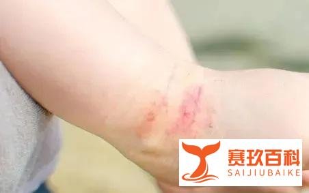 注意！近期高发，中国2亿人被它折磨...