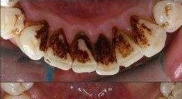 杭州洗牙一般要多少钱，洗牙需要多长时间？