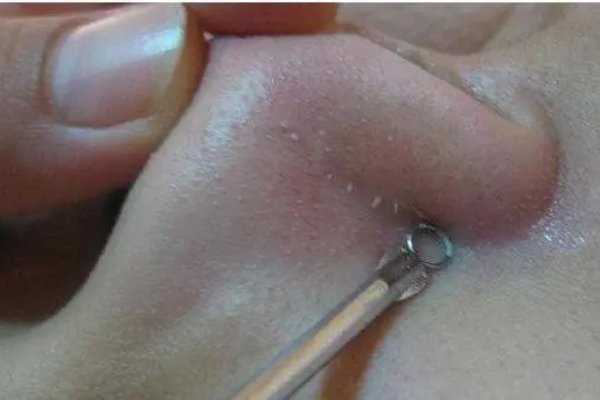 6年级小学生皮肤挤出白色东西是怎麽回事?